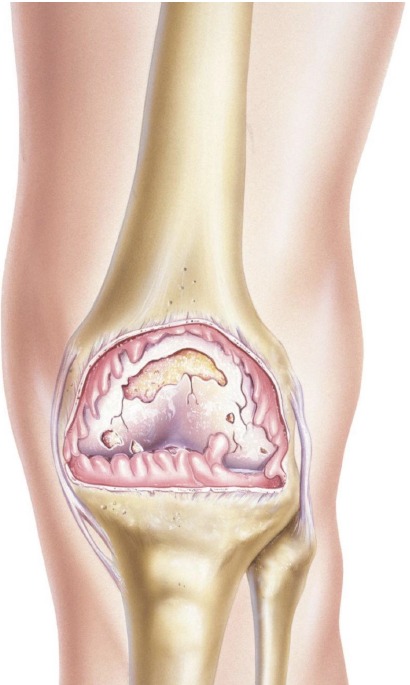 Early signs of knee arthritis and knee pain treatment in Bangalore
